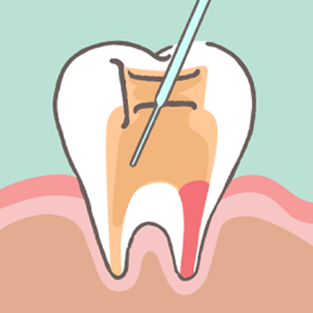 신경관 소독/내부 충전