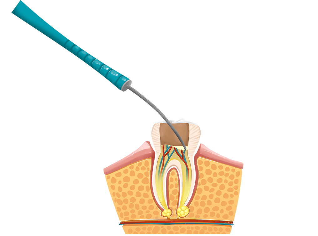 신경치료 정의 이미지