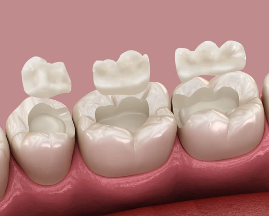 인레이 상세 이미지