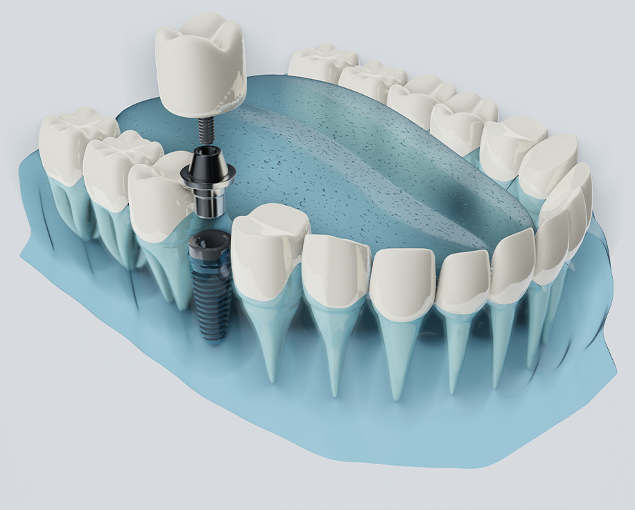 임플란트 맞춤 보철 정의 이미지