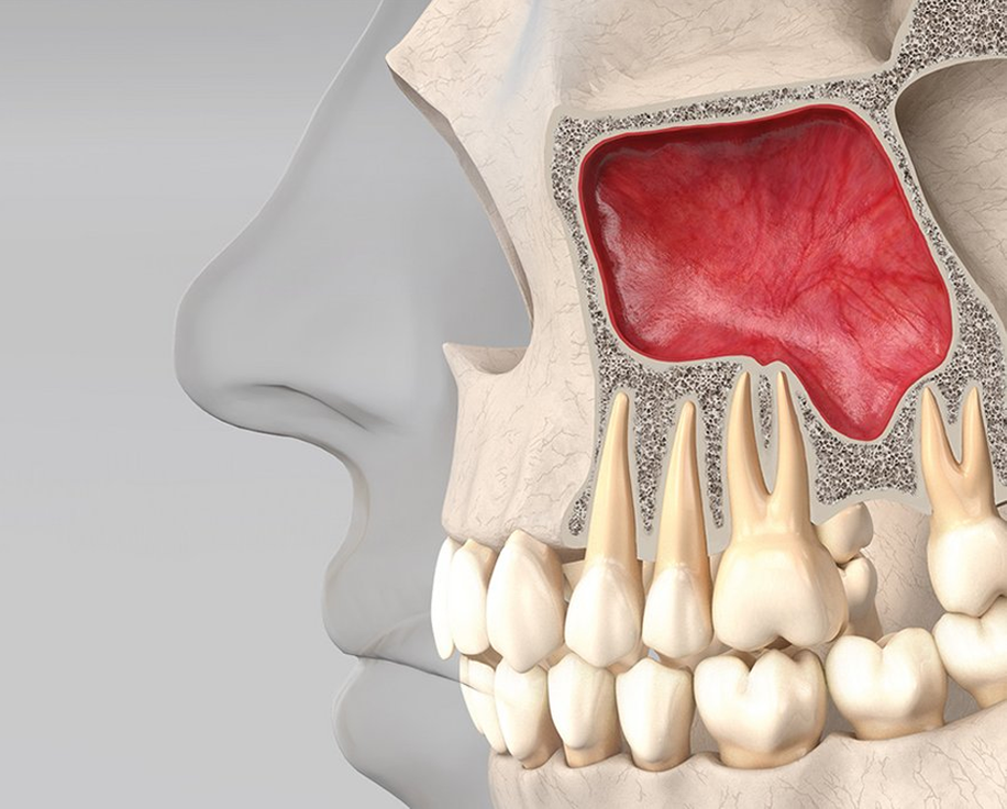 상악동 거상술 정의 이미지