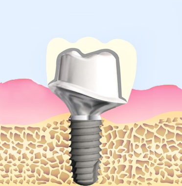 맞춤 지대주 구조