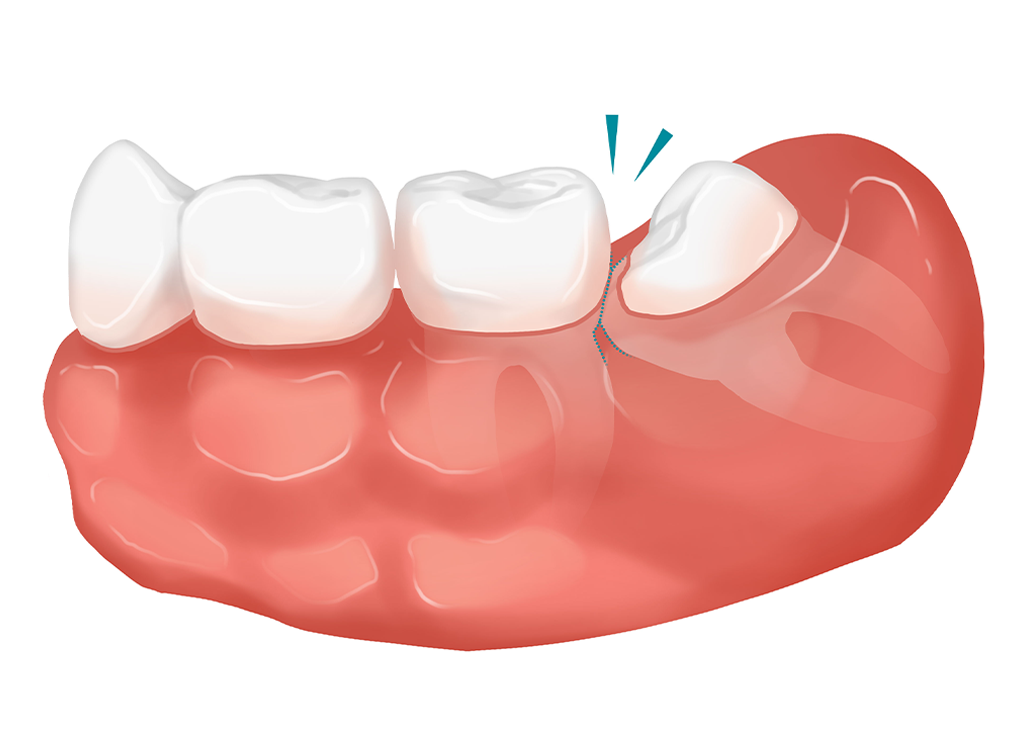 사랑니 발치 이미지